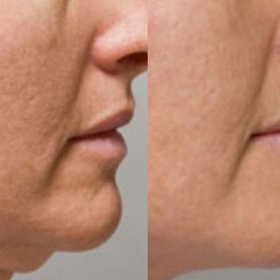 ziba's Spa RF Treatment for Facial and Neck Skin Tightening and Lifting